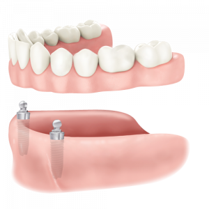 Removable Dentures on Implants in Moncton