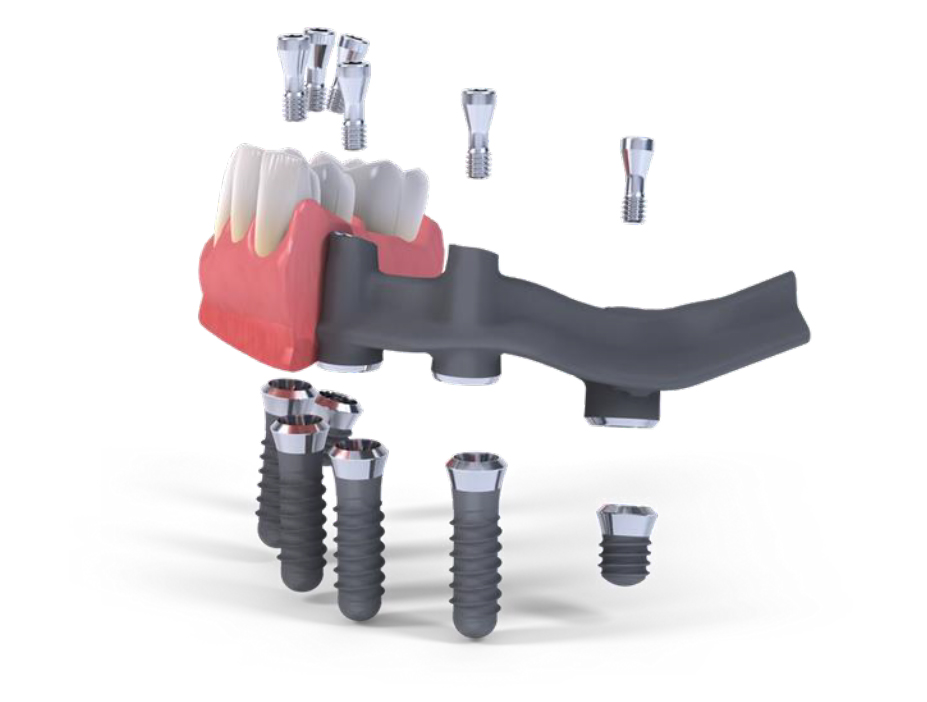 fixed dentures on implants at dieppe denture clinic