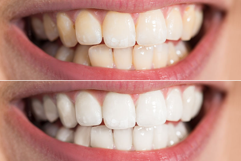 before and after picture of bleached dentures